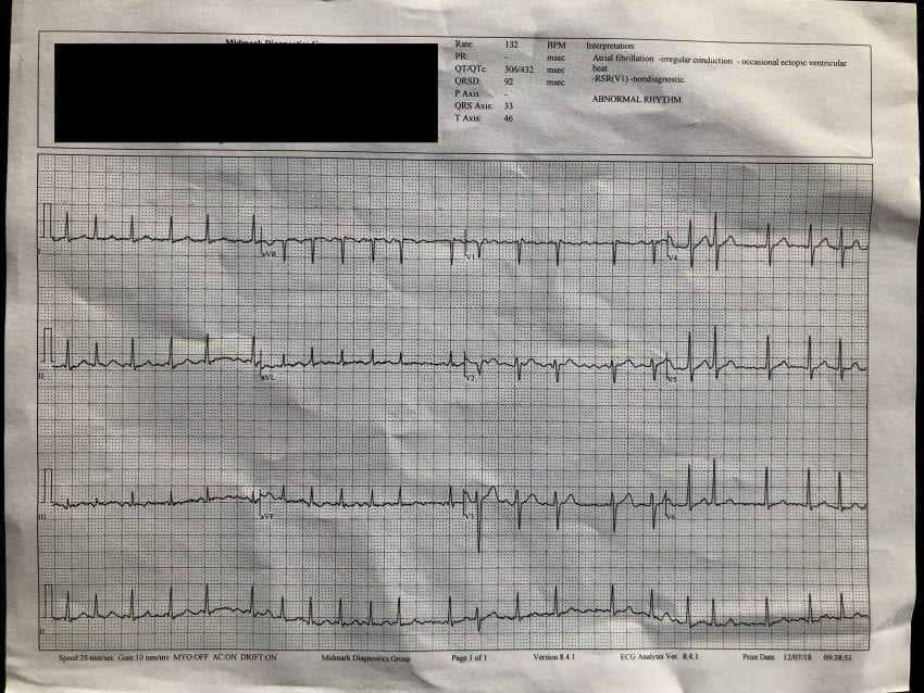 ecg