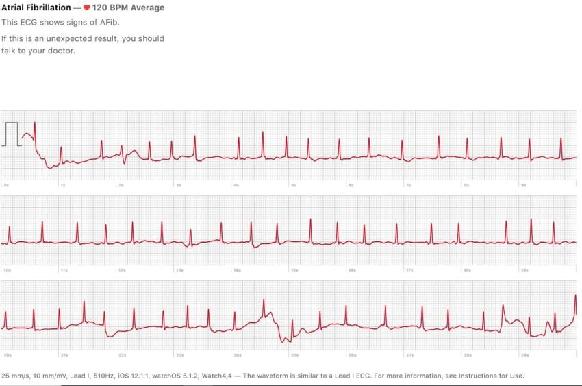 ecg apple watch